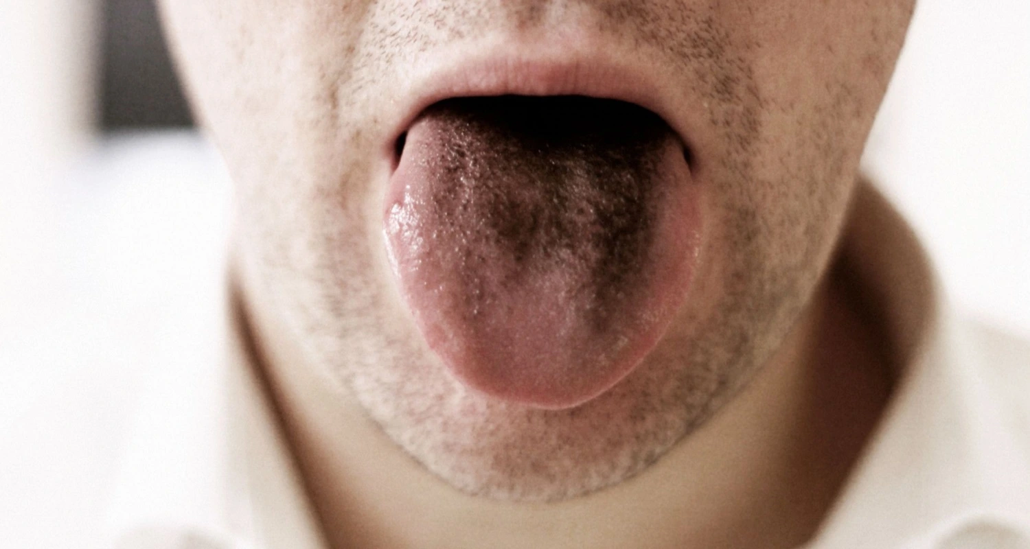 man is showing black hairy tongue