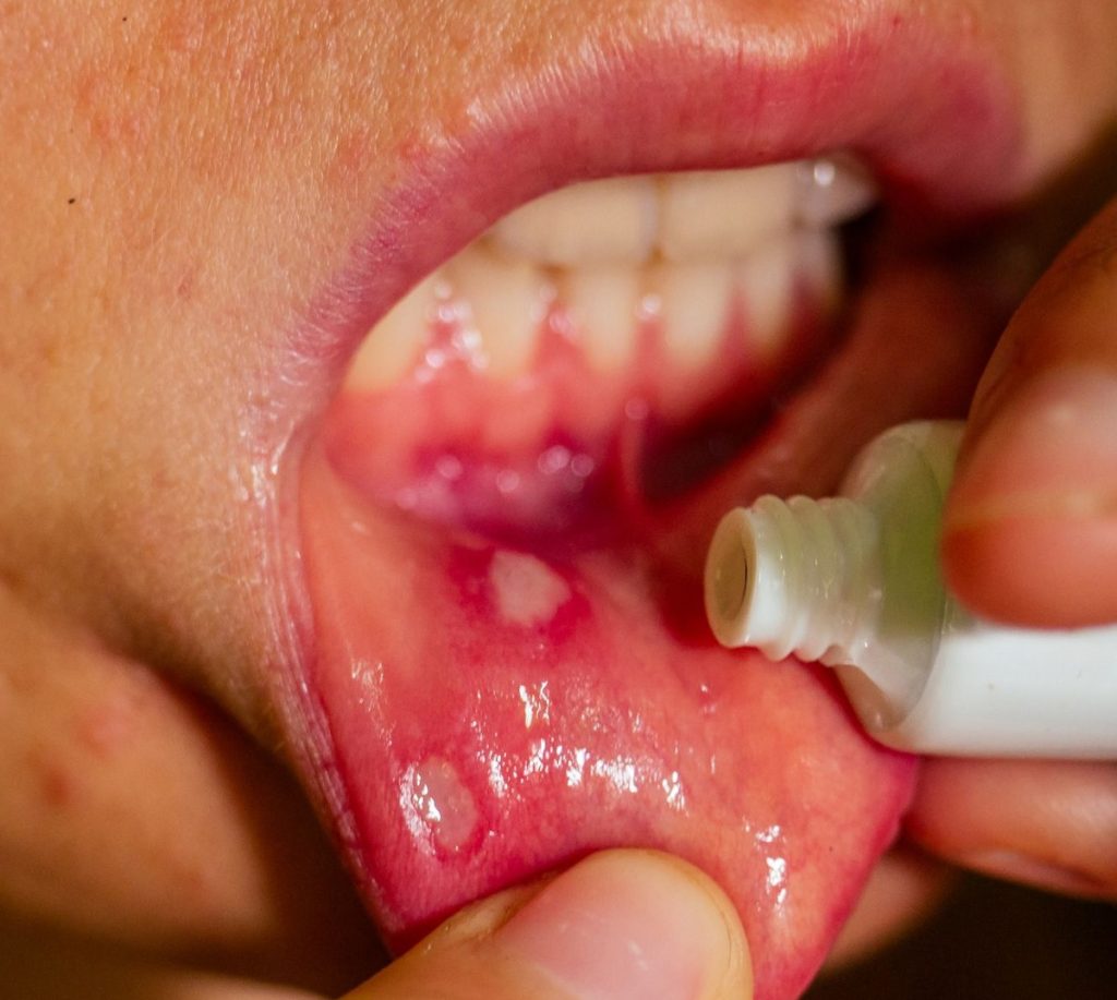 aloe vera to mouth ulcer featured - Aloe vera para aliviar las úlceras bucales