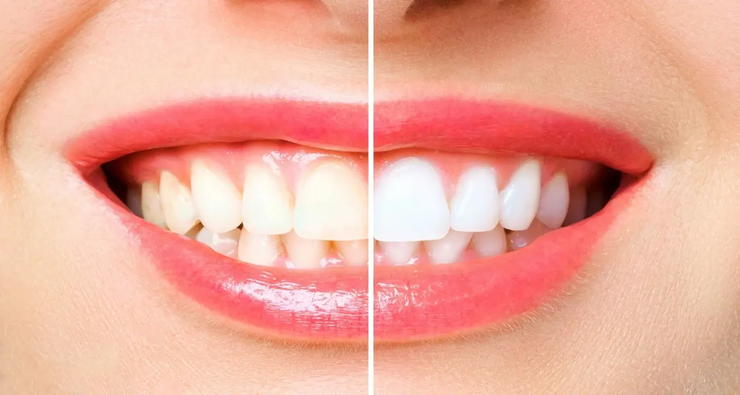 blue or gray teeth