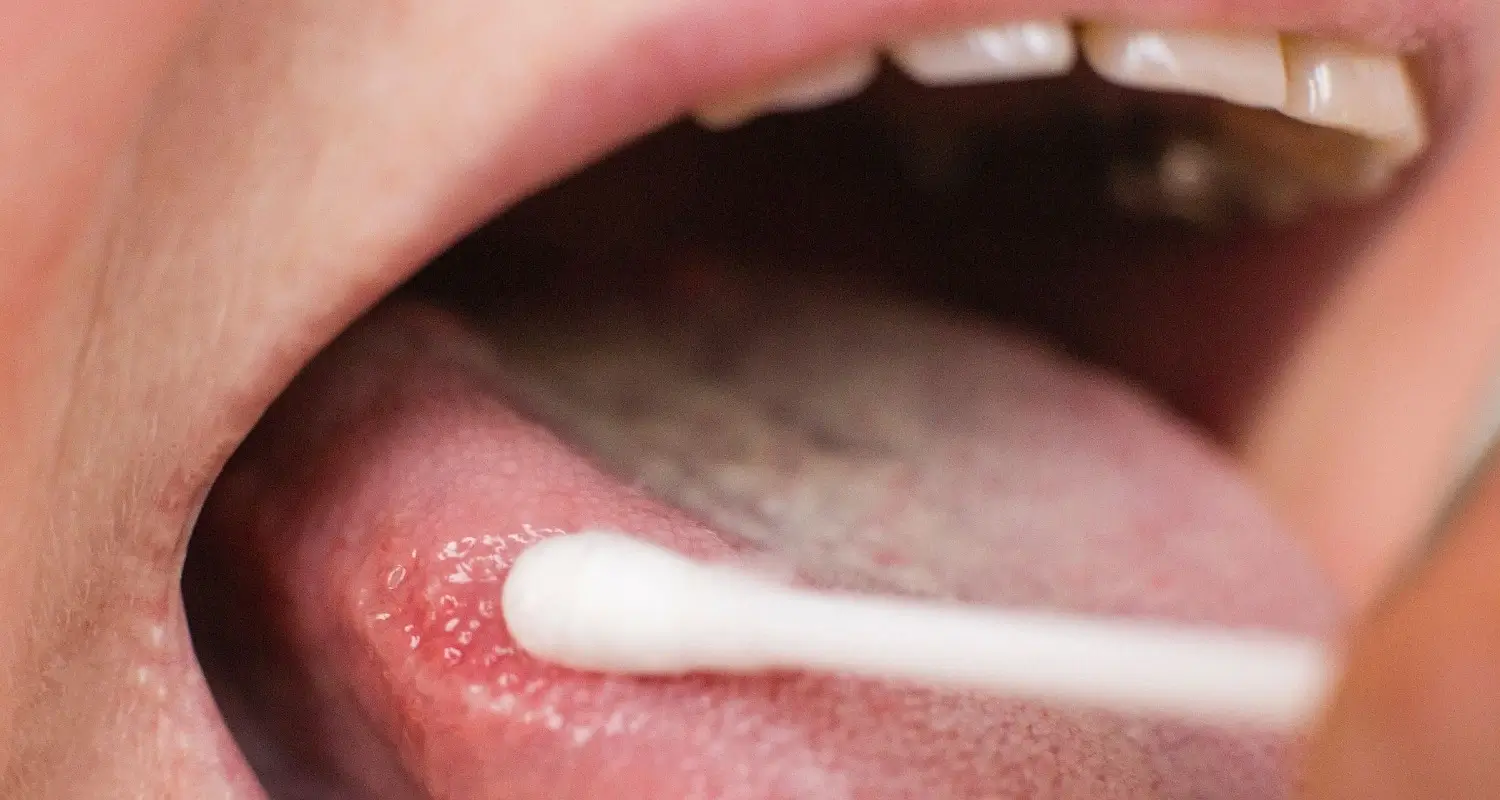 bumps on the tongue 