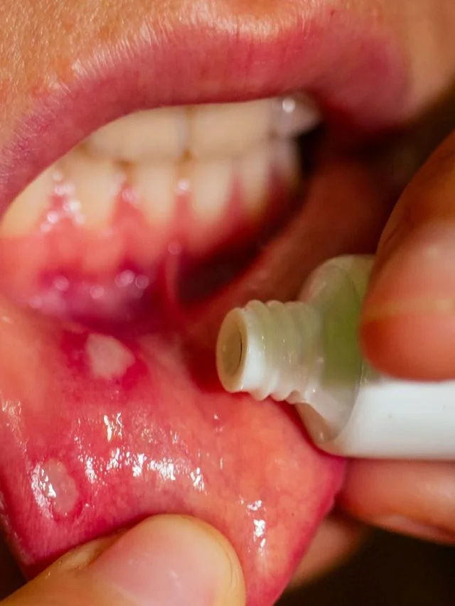 aloe vera to mouth ulcer featured