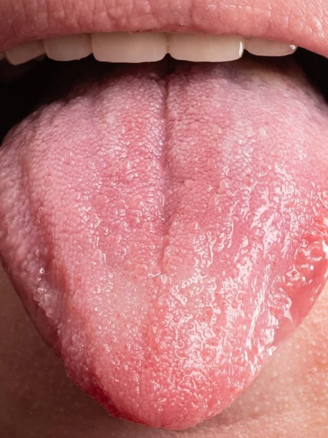 bumps on the back of the tongue