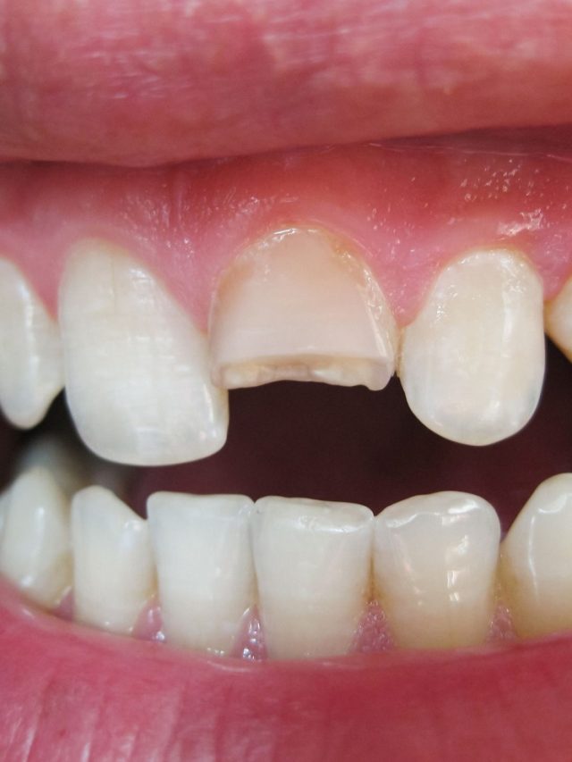 What Is Eye Tooth? 5 Definitive Functions