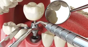 dental implant procedure