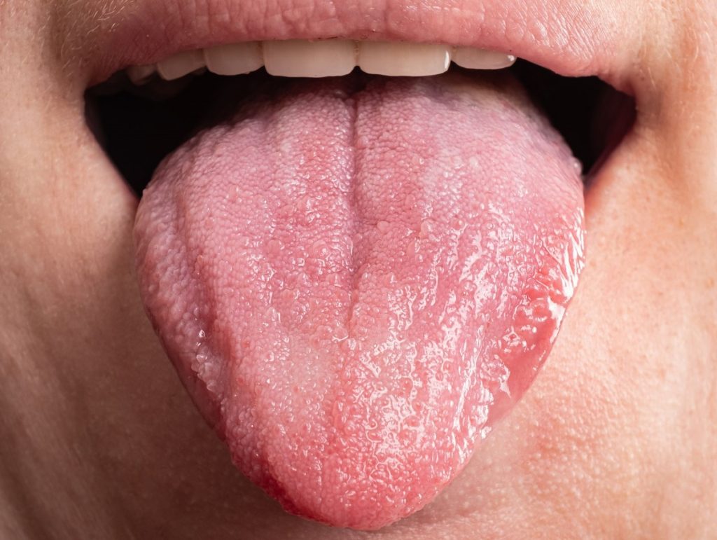 bumps on the back of the tongue - Bultos en la parte posterior de la lengua