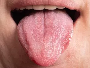 bumps on the back of the tongue - Bultos en la parte posterior de la lengua