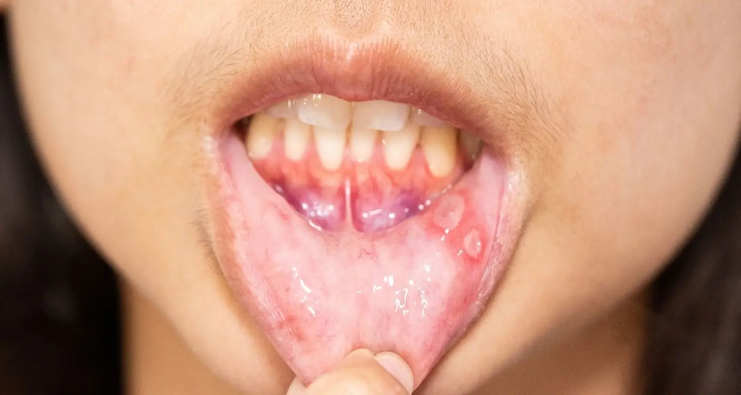 mouth ulcer 