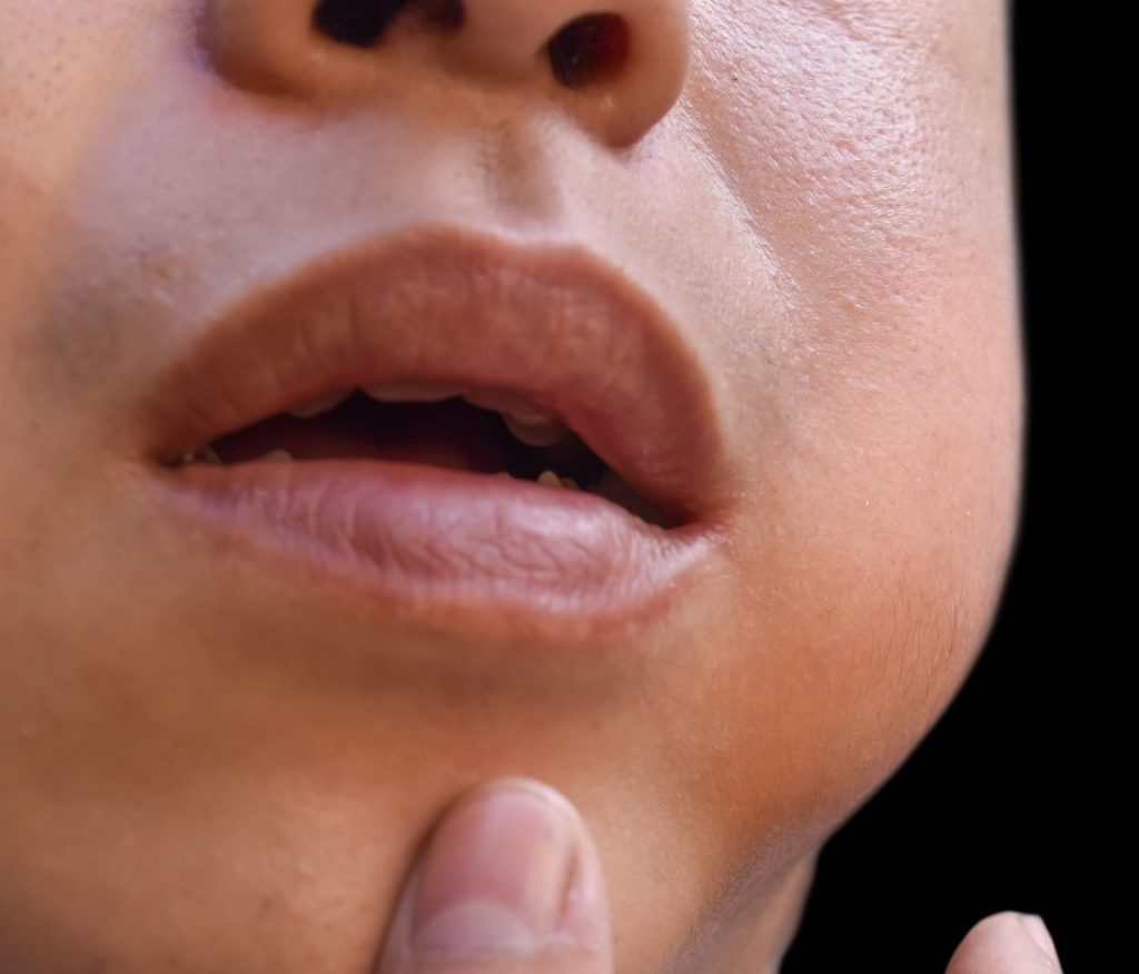 pleomorphic adenoma featured - Adenoma Pleomórfico
