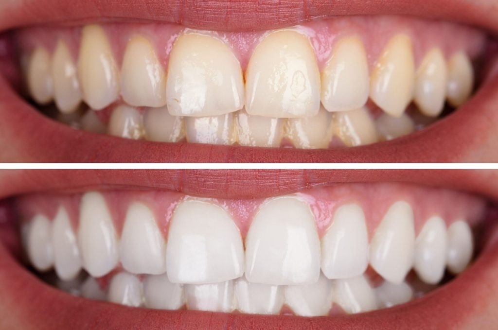 dientes azules o grises