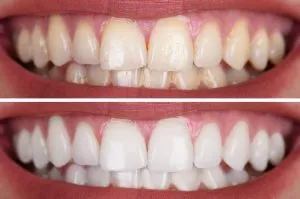 dientes azules o grises