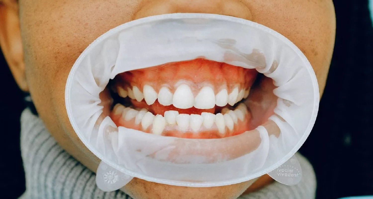 3 Essential Stages of Trench Mouth Treatment You Should Know 6 trench mouth