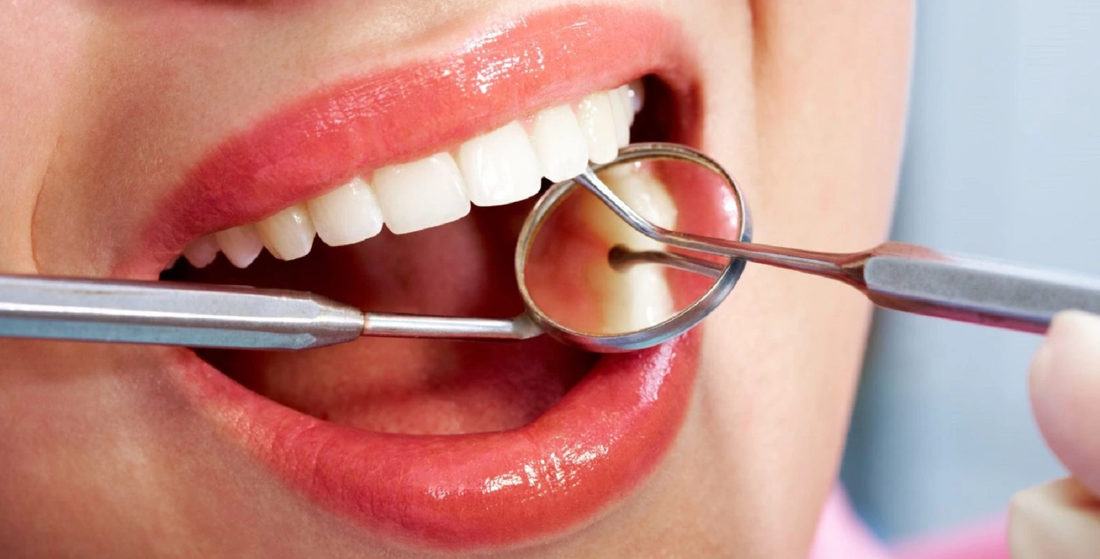 what is dental bonding