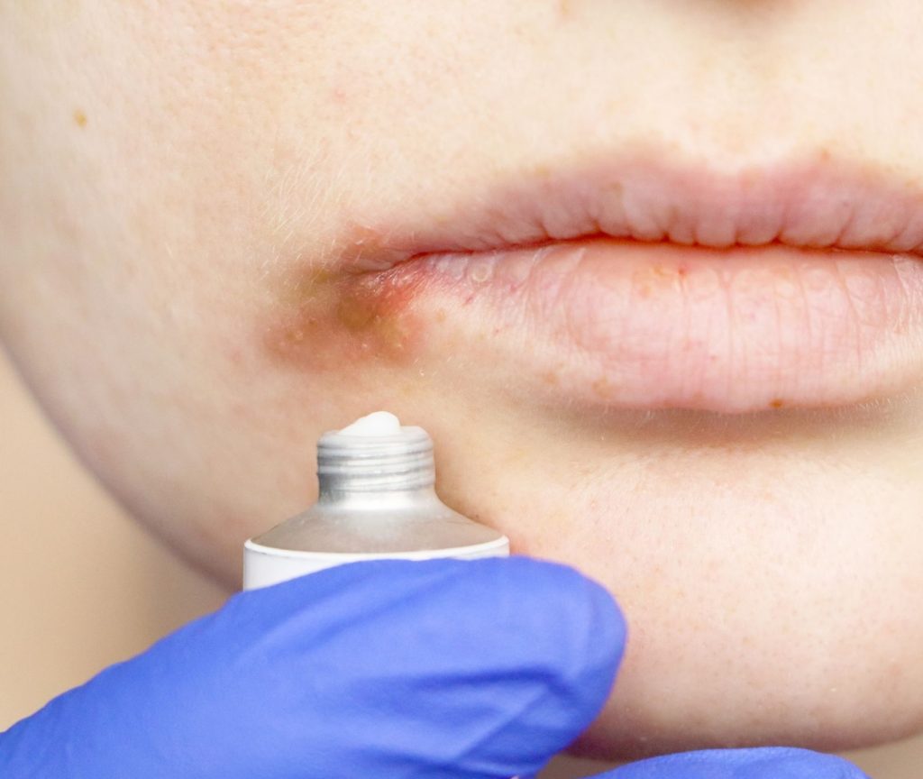 cold sore - tratamientos para el herpes bucal