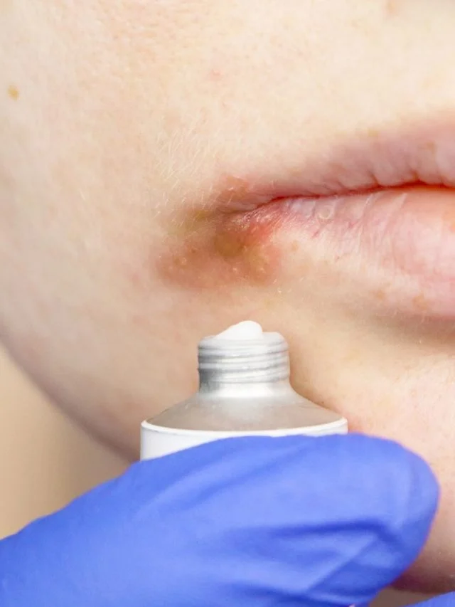 cold sore treatment featured