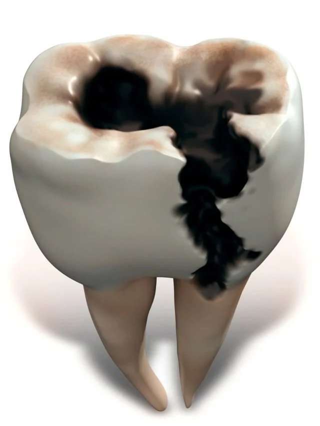 decayed wisdom tooth featured