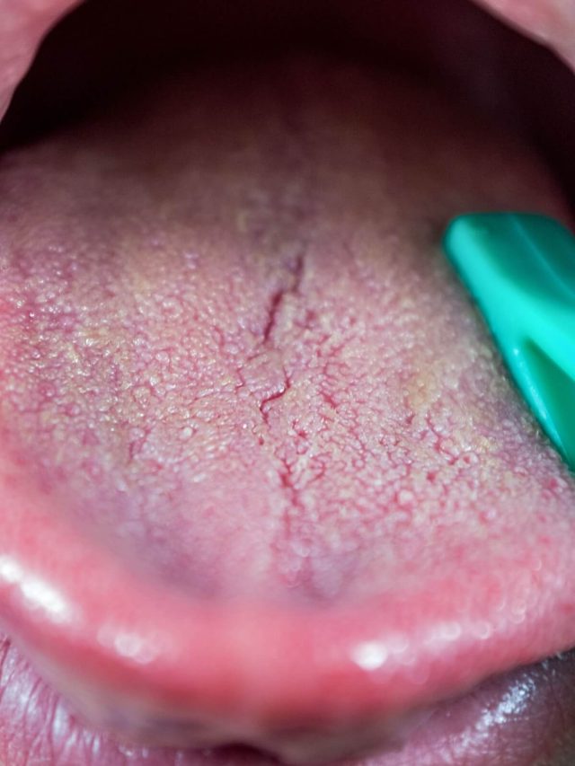 7 Useful Tips: Learn What is Fissured Tongue and Its Causes