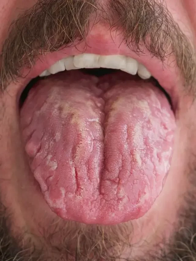 what is fissured tongue
