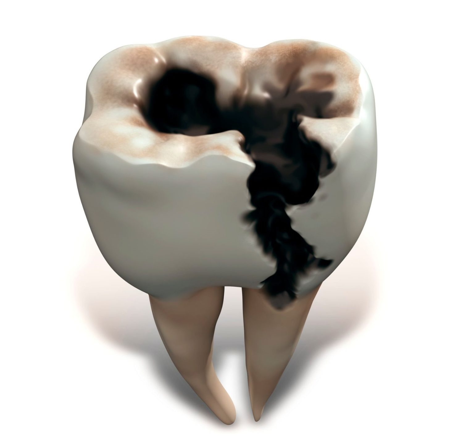 decayed wisdom tooth featured