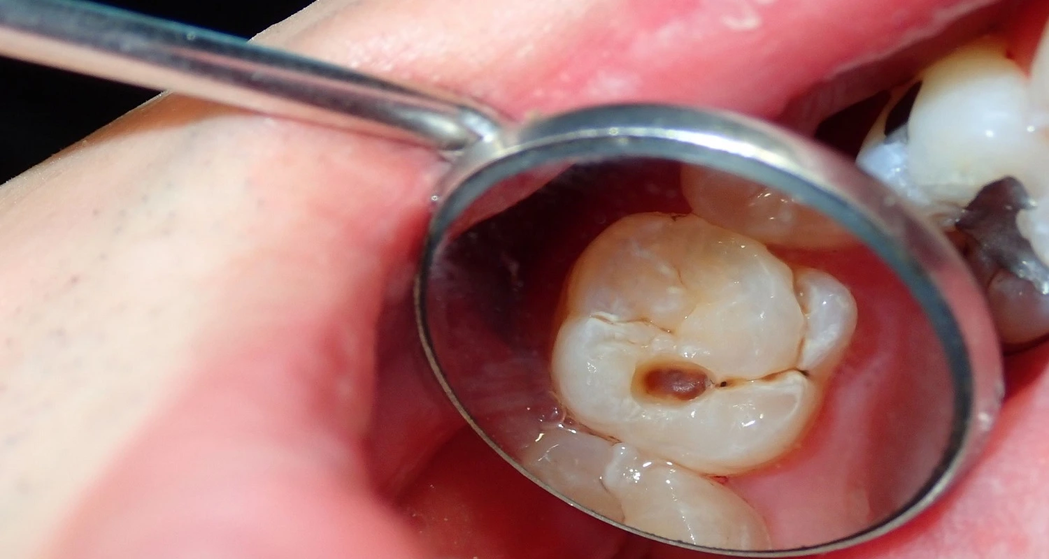 decayed wisdom tooth