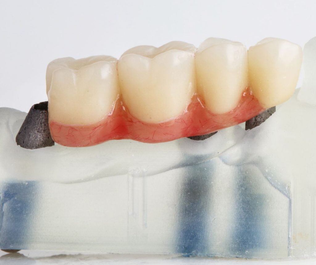 alternativas a los implantes dentales