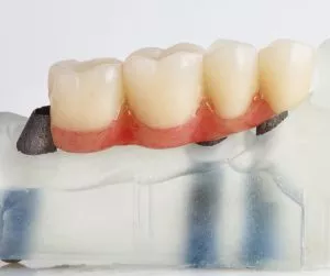 alternativas a los implantes dentales
