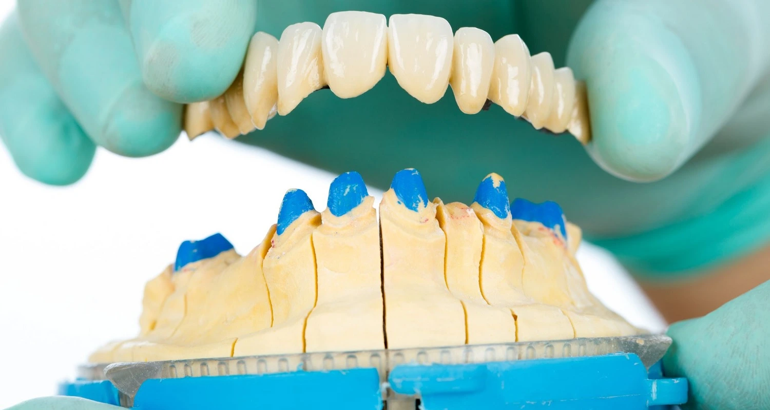 dental implant alternatives