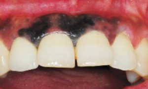 melanoma in the mouth