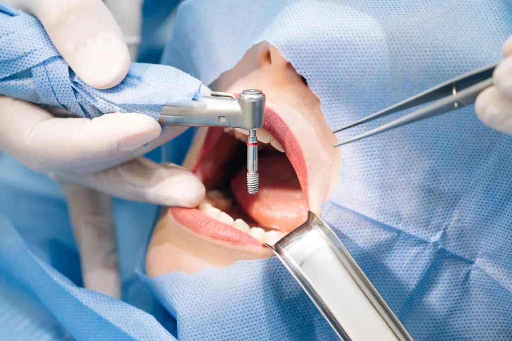 Cirugía de implantes dentales en 7 sencillos pasos
