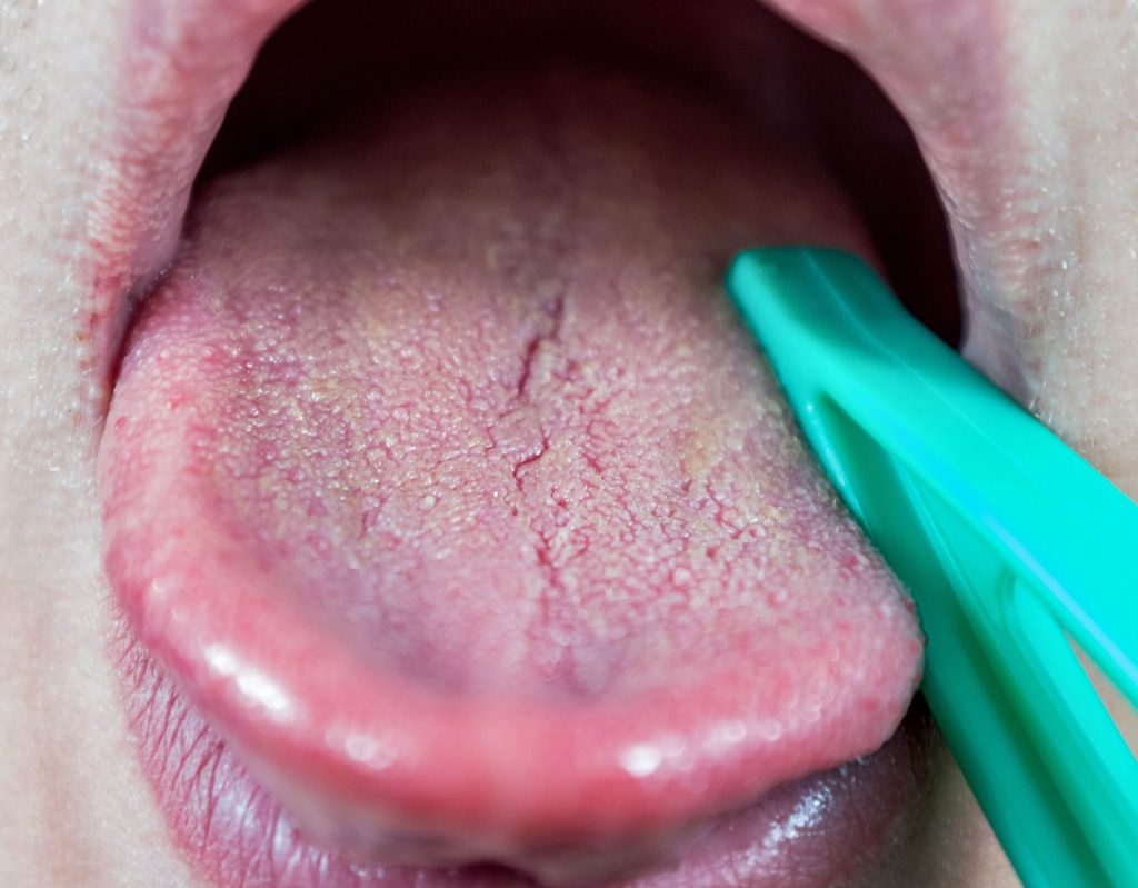 what is featured tongue featured - la lengua fisurada