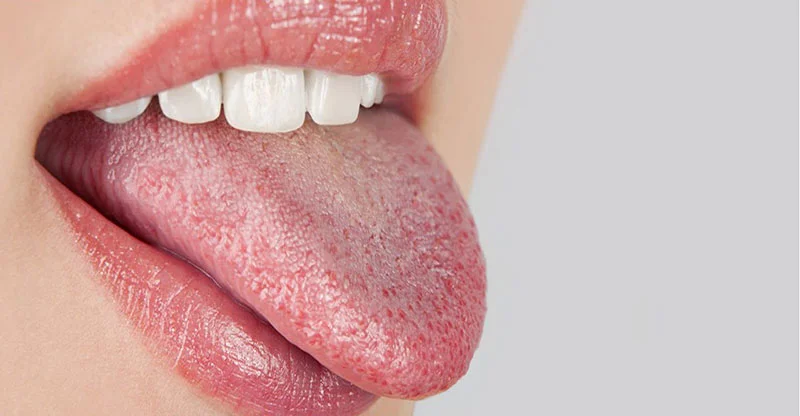Spironolactone and Dry Mouth: 9 Effective Alternatives