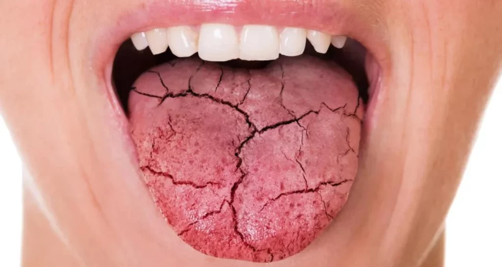 Carvedilol and Dry Mouth: 6 Effective Recommendations