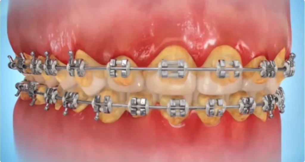 Mala Higiene Oral en Pacientes con Brackets