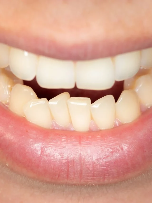 Malocclusion of teeth or crowded teeth