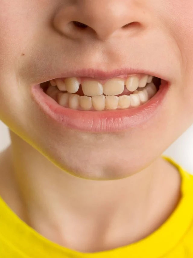 child with Malocclusion