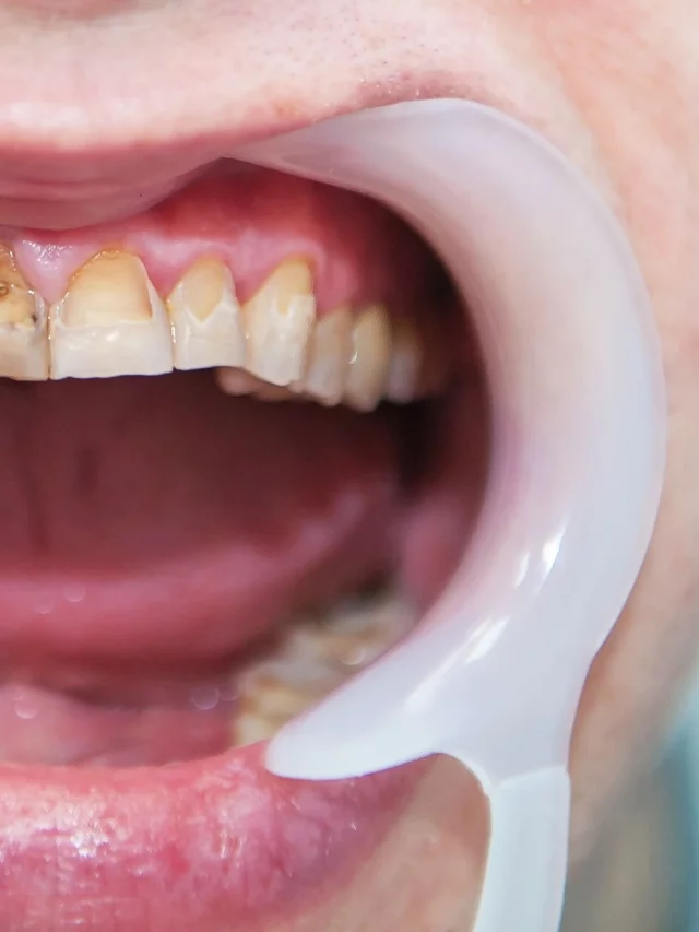 dental fluorosis featured