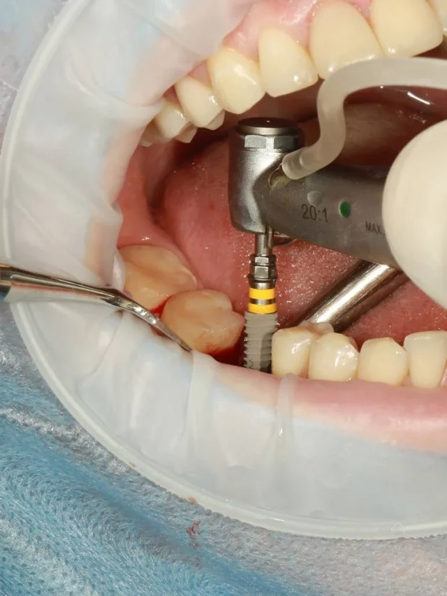 how to prepare for dental implant surgery