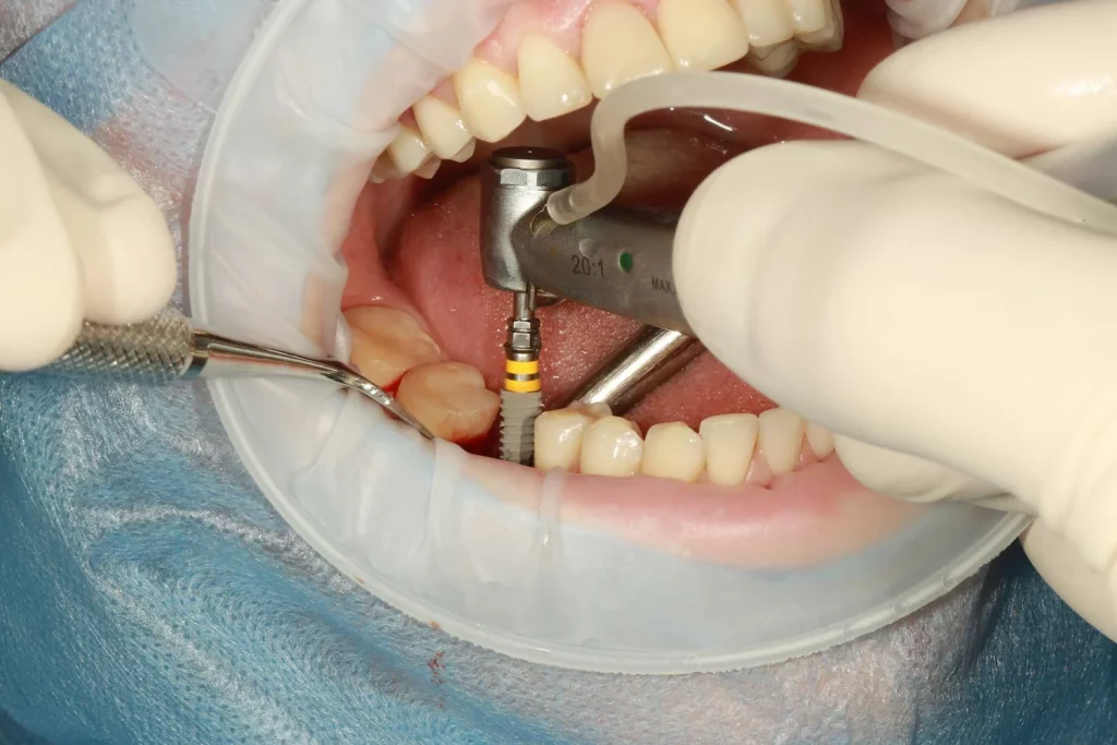 how to prepare for dental implant surgery