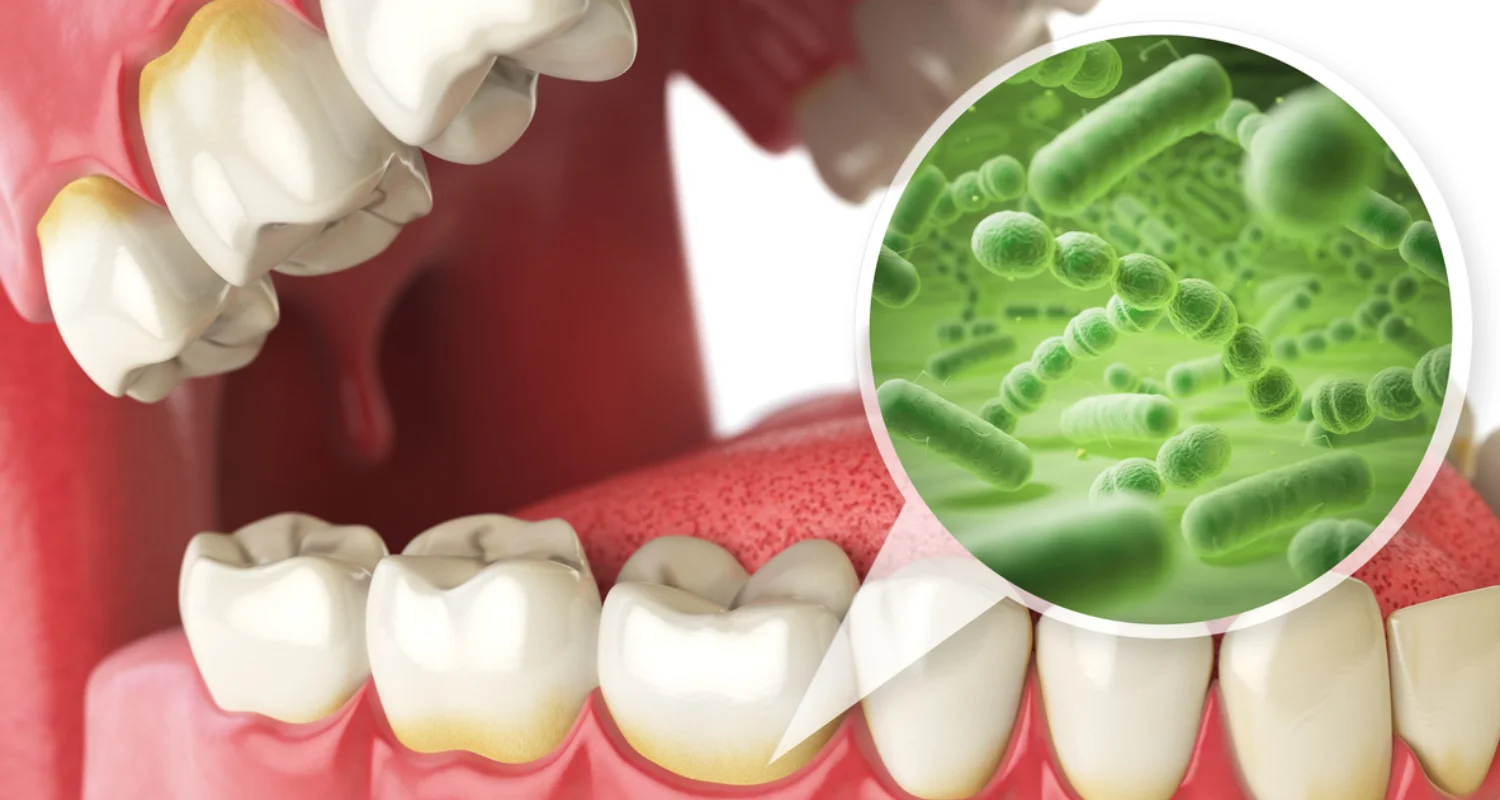 Las Caries Pueden Causar Mal Aliento || Can Cavities Cause Bad Breath