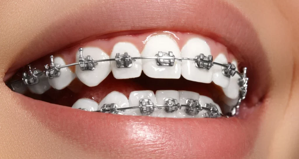 teeth--with-braces