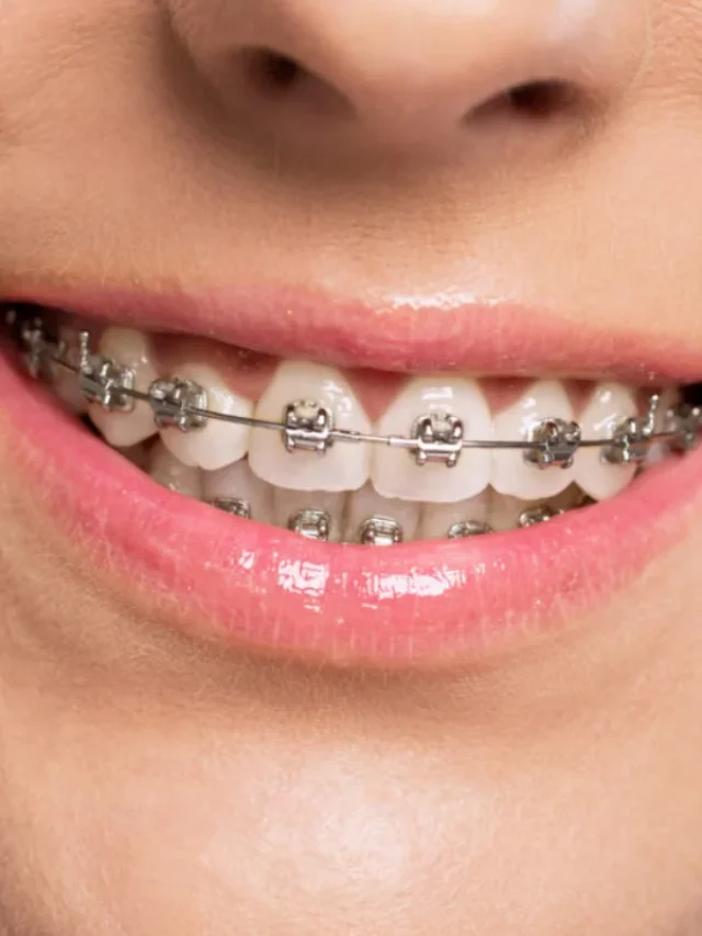 Prevención de problemas de ortodoncia