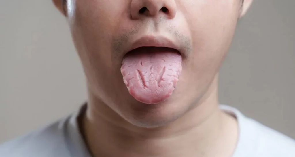 ¿Qué es la lengua fisurada