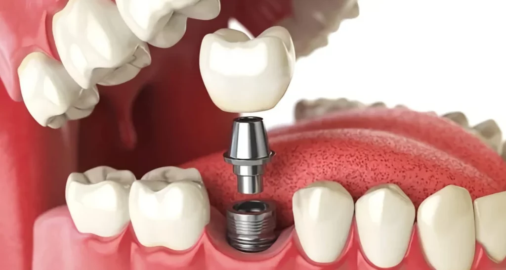 implantes dentales (1)