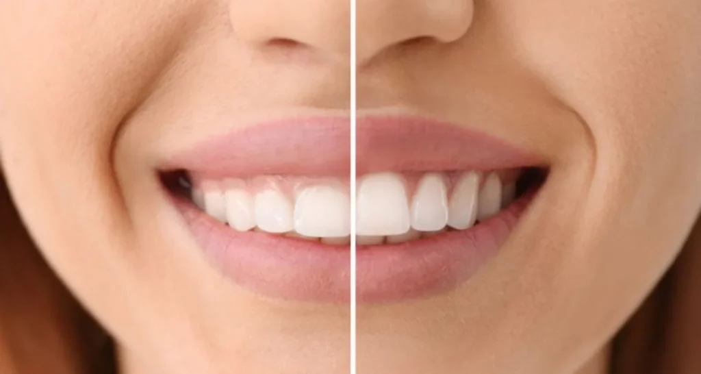 What is Crown Elongation?