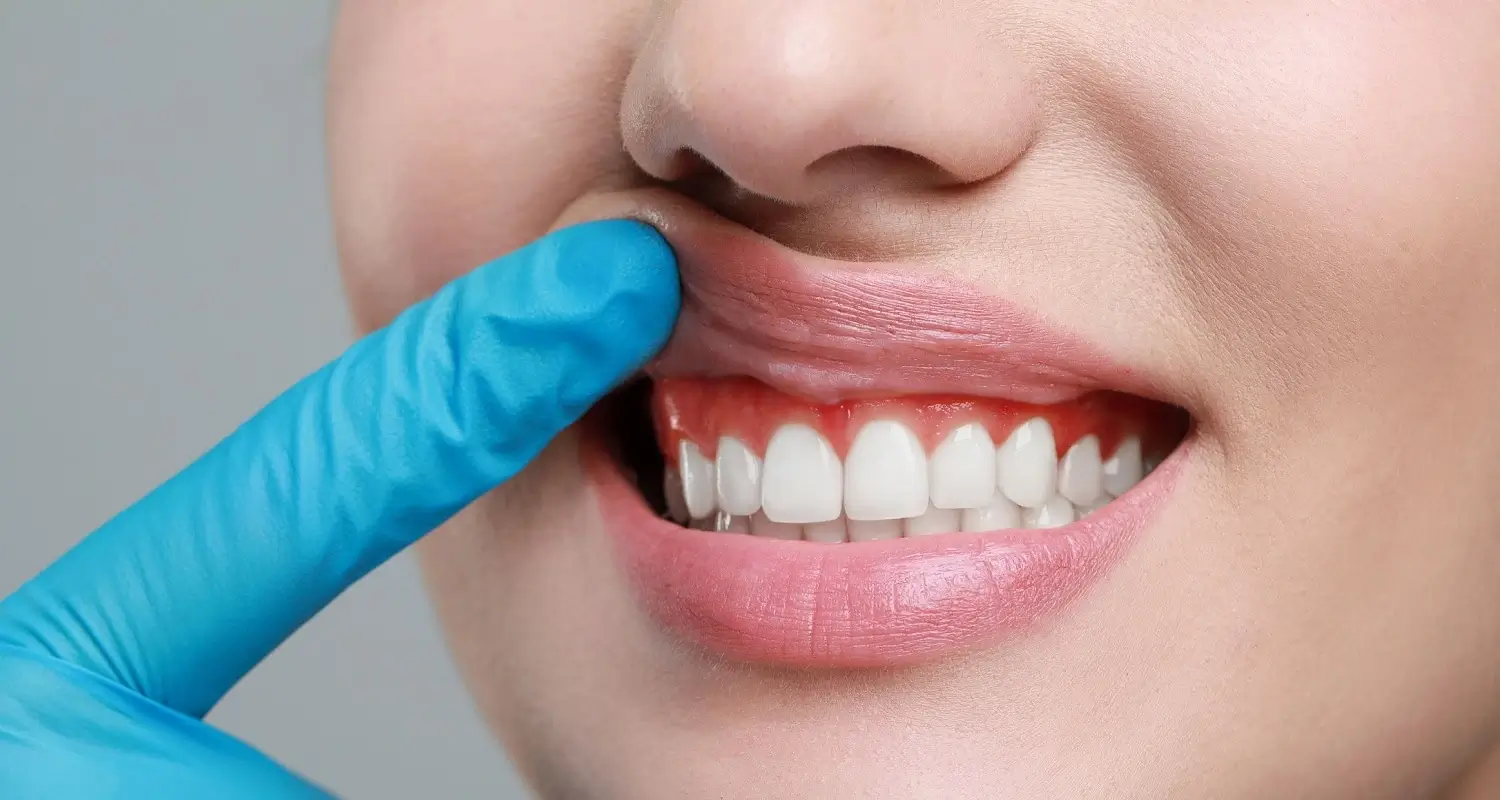 5 Proven DIY Remedies for Gum Inflammation at Home