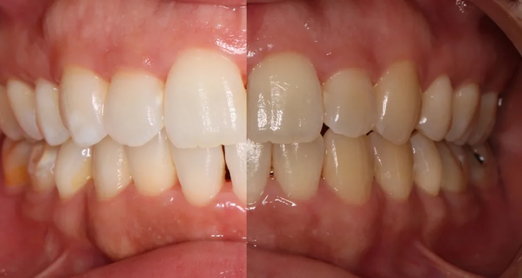 ¿Cómo Actúa El Peróxido De Hidrógeno En El Blanqueamiento Dental Casero