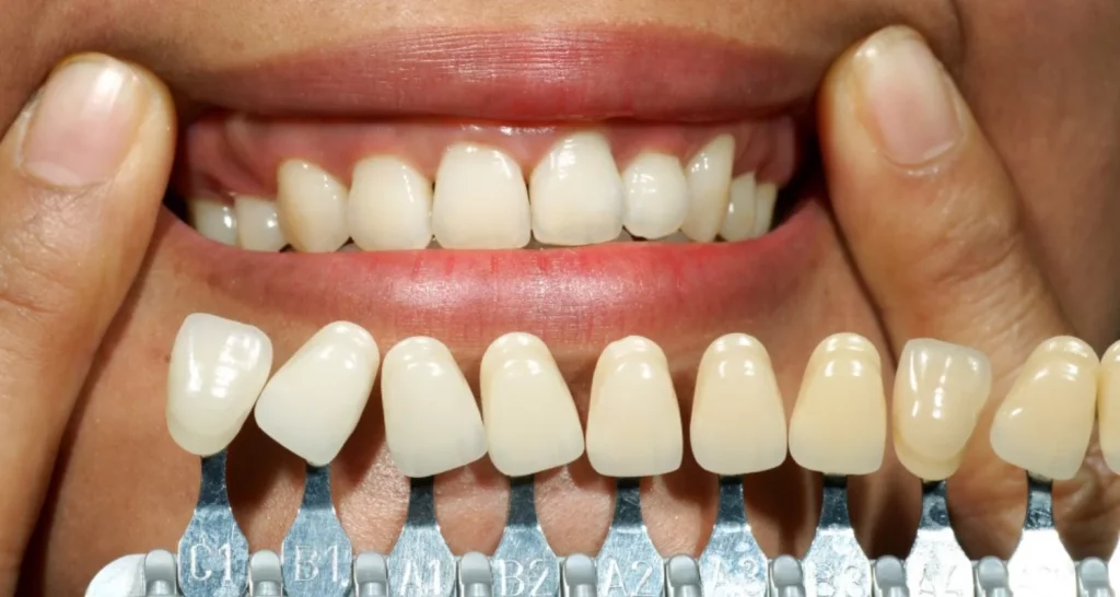 How Much Does Dental Bonding Cost Per Tooth