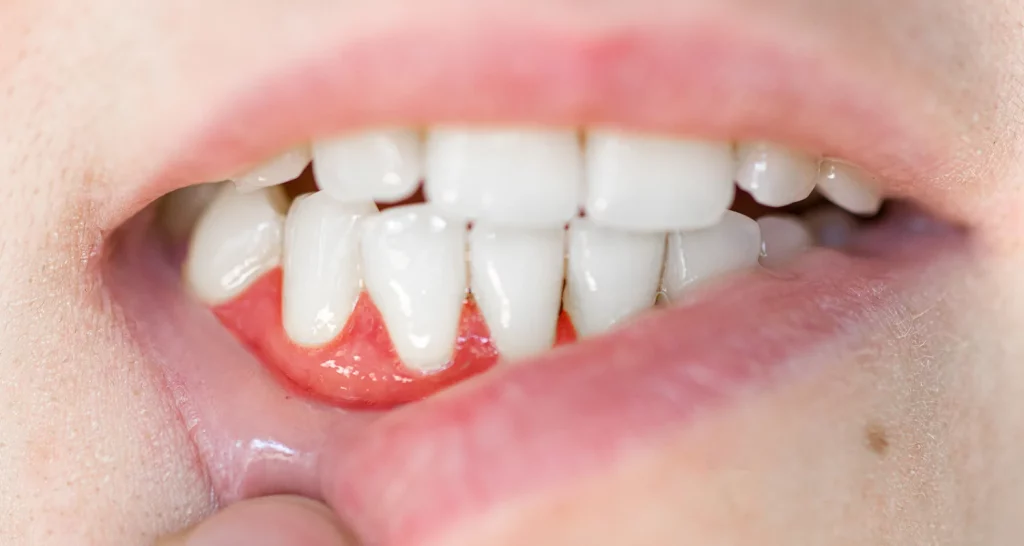 How to Drain a Tooth Abscess at Home