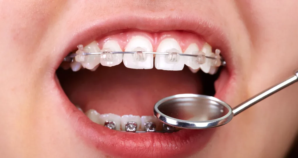 ¿Cuál es el tratamiento para el apiñamiento dental