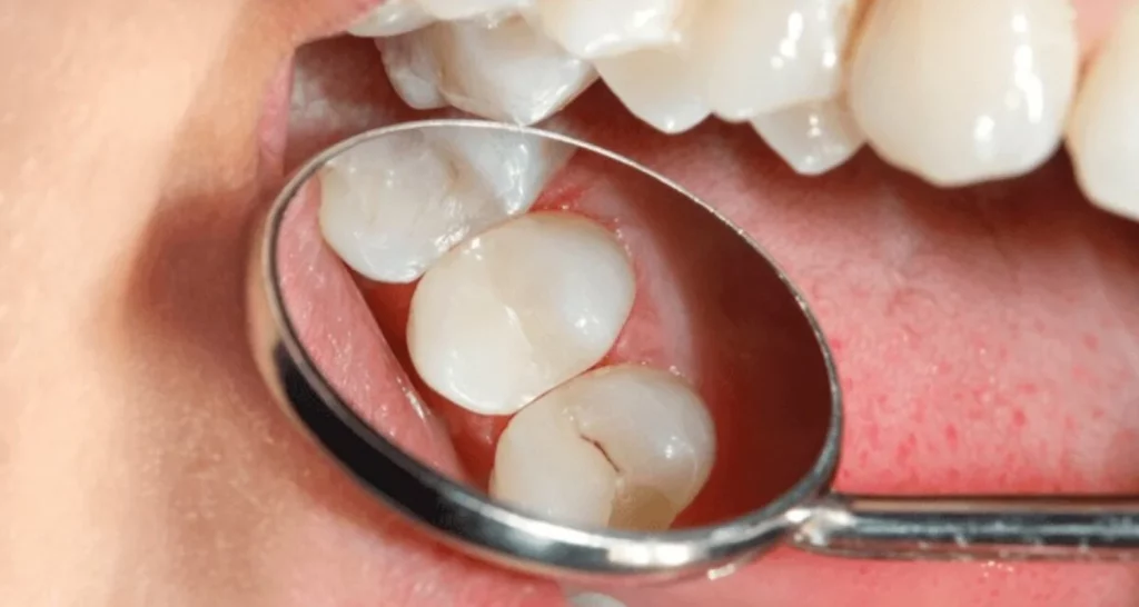 ¿Cuáles son las complicaciones de no tratar un apiñamiento dental