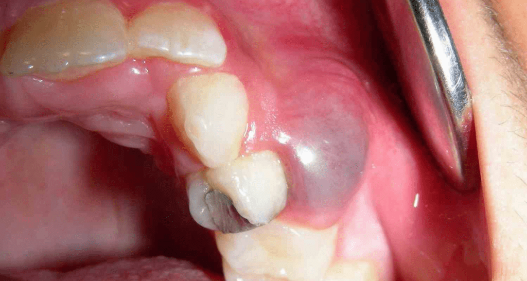 ¿Cuáles son los síntomas de los quistes dentígeros